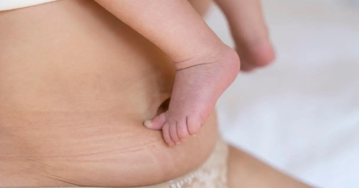 Postpartum Recovery showing a mother's postpartum belly with stretch marks and her baby's tiny feet, highlighting the natural healing process after pregnancy.