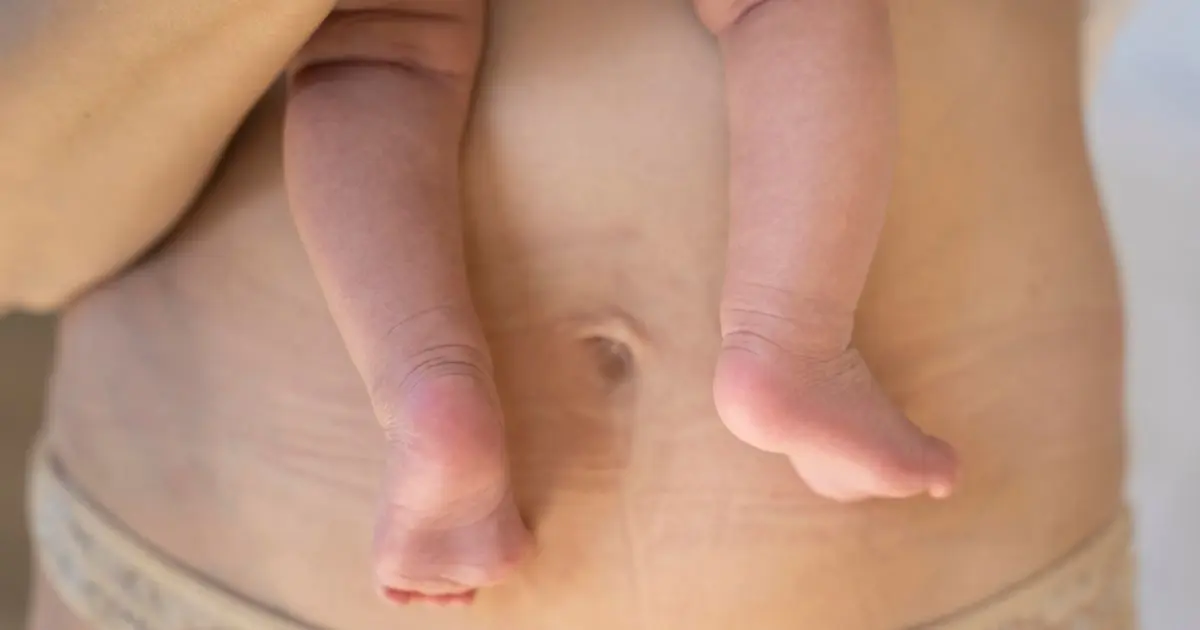 Postpartum Recovery showing a mother's postpartum belly with stretch marks and her baby's tiny feet, highlighting the natural healing process after pregnancy.