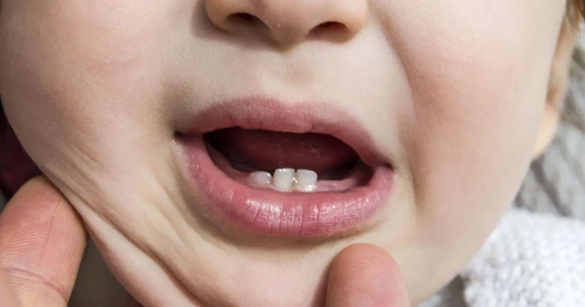 Baby teething close-up showing first tiny teeth emerging from gums
